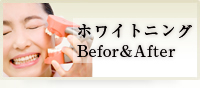 ホワイトニング Befor&After